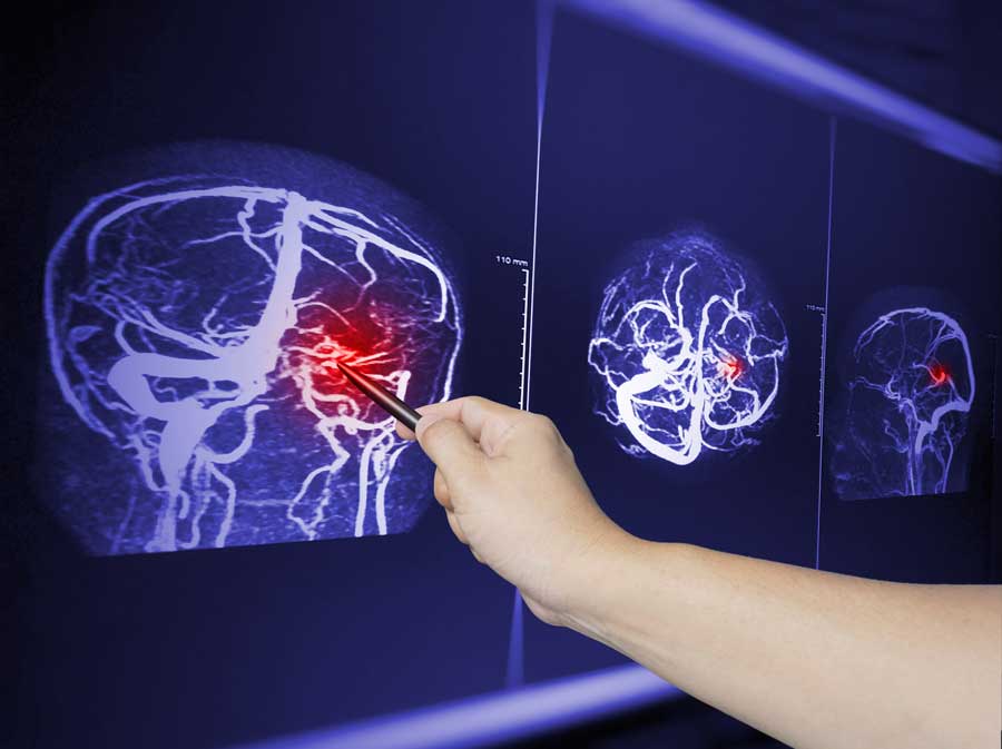 Signs of a Traumatic Brain Injury