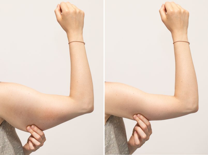 Feel Smooth, Firm, and Victorious With Bipolar Radiofrequency