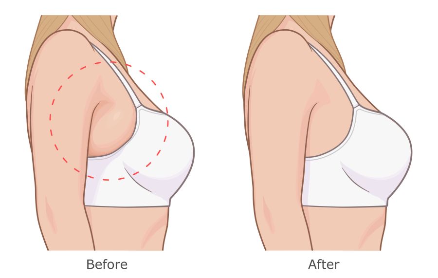 What to Expect During a Bra Bulge Cryo Sculpting Session