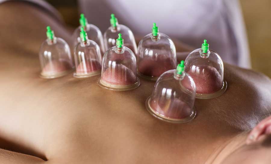 The Benefits of Cupping