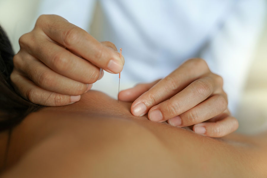 Are Dry Needling and Acupuncture the Same Thing?